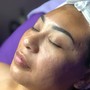 Microdermabrasion