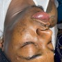 Acne Facial