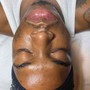 Microdermabrasion