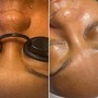 Flesh Glow facial (Dermaplaning)