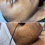 Face Reality acne program consultation +treatment (INITIAL VISIT)