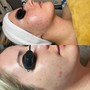 Acne facial