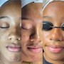 Face Reality acne program consultation +treatment (INITIAL VISIT)