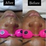 Acne Facial