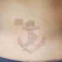 Glycolic Acid Tattoo Removal