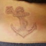 Saline Tattoo Removal 1st session