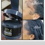 Hair loss treatment