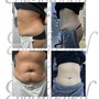 RF Skin Tightening