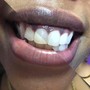 Teeth Whitening (free aftercare kit)