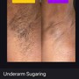 Underarm Sugaring