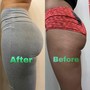 Love Handles (Side + Back Treatment)