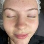 High Frequency Facial