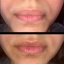 Lips- 1 mL Filler