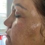 Glycolic Peel