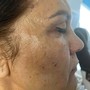 Microdermabrasion