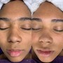 Acne Facial