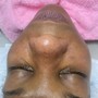 Microdermabrasion