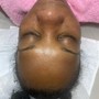 Microdermabrasion