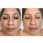 Microdermabrasion Treatment