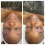 Chemical Peel