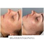 Microdermabrasion Facial