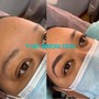 MicroNeedling