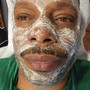 Microdermabrasion