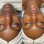 Microdermabrasion