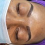 Dermaplaning