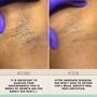 Chin Sugaring