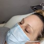 Microdermabrasion