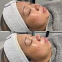 Hydrafacial