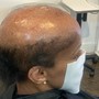 Scalp Treatment