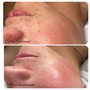 Hyperpigmentation Facial