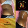 RF Skin Tightening