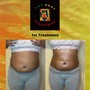 Ultrasonic Waist Melt