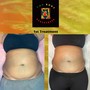 Ultrasonic Fat Cavitation