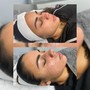 Chemical peel