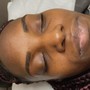 Microdermabrasion