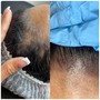 Scalp Micropigmentation