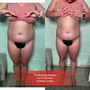 Ultrasonic Fat Cavitation