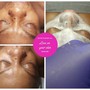 Microdermabrasion Hydration Treatment (Wet/Dry Microdermabrasion)