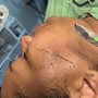 RF Skin Tightening