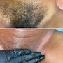 Dermaplaning Facial