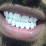 Full set 20 veneers