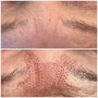 MicroNeedling