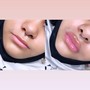 Hyaluron Lip Filler 1ml (1 session)