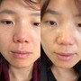 Acne Facial