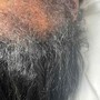 Scalp Micro Pigmentation(Front Edges)