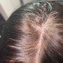 Scalp Micro Pigmentation(Front Edges)